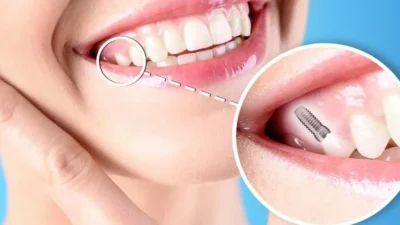 Discover The Best Dental Implant Options For A Winning Smile